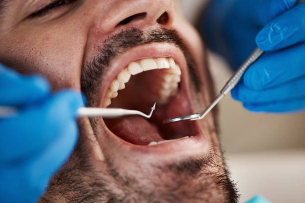Best Dental Abscess Treatment in Swainsboro, GA